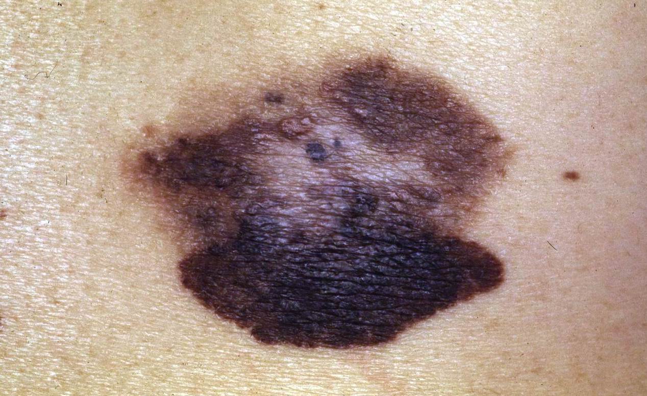 neoplasia alla prostata è benigna o malignant melanoma